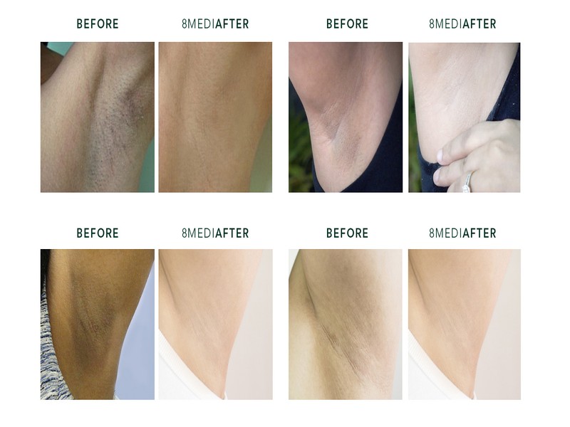 How to Treat Underarm Ingrown Hairs A Complete Guide